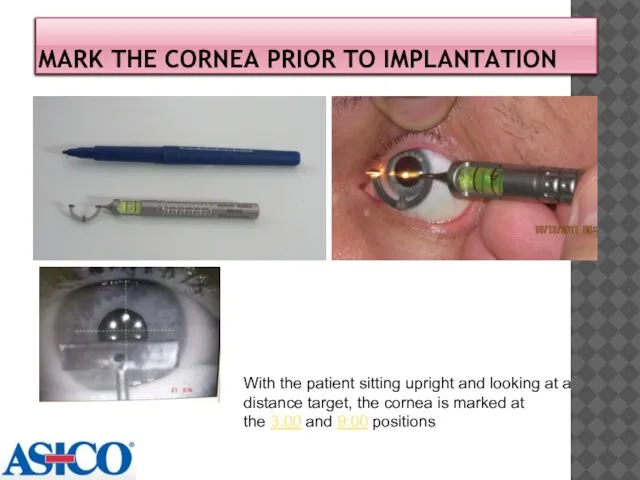 Mark the cornea prior to implantation With the patient sitting upright and