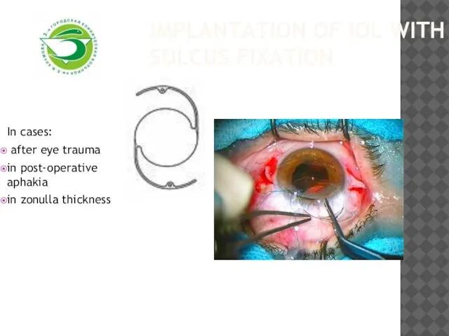 Implantation of IOL with sulcus fixation In cases: after eye trauma in