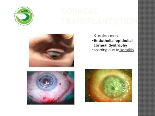 Corneal transplantation Keratoconus Endothelial-epithelial corneal dystrophy scarring due to keratitis