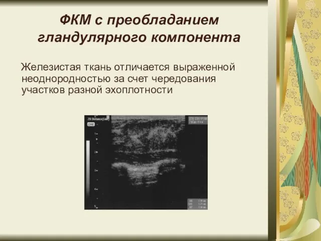 ФКМ с преобладанием гландулярного компонента Железистая ткань отличается выраженной неоднородностью за счет чередования участков разной эхоплотности