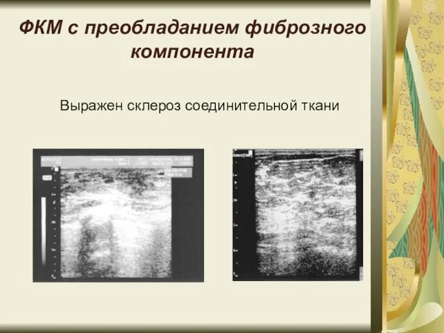 ФКМ с преобладанием фиброзного компонента Выражен склероз соединительной ткани