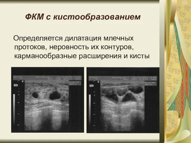 ФКМ с кистообразованием Определяется дилатация млечных протоков, неровность их контуров, карманообразные расширения и кисты