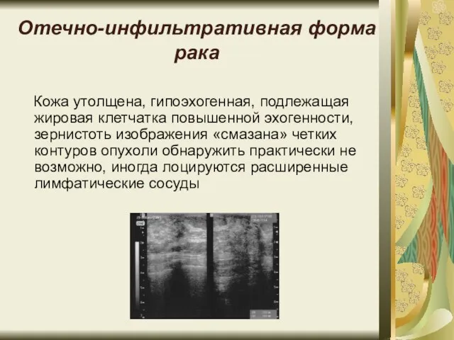 Отечно-инфильтративная форма рака Кожа утолщена, гипоэхогенная, подлежащая жировая клетчатка повышенной эхогенности, зернистоть