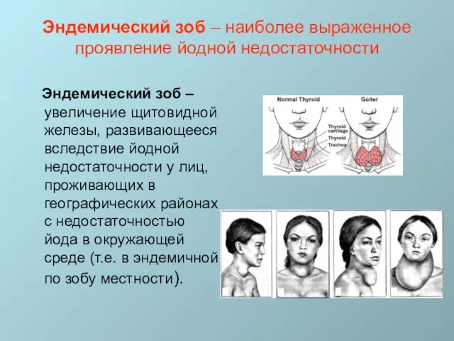 Эндемический зоб – наиболее выраженное проявление йодной недостаточности Эндемический зоб – увеличение