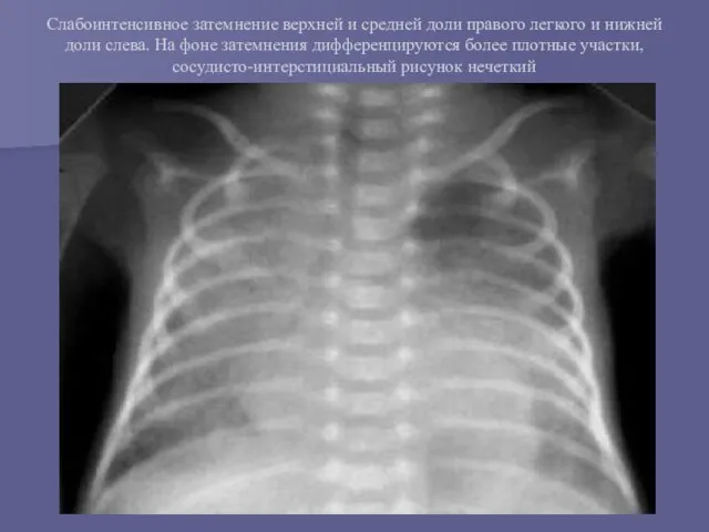 Слабоинтенсивное затемнение верхней и средней доли правого легкого и нижней доли слева.