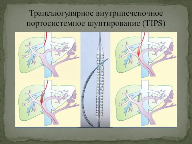 Трансъюгулярное внутрипеченочное портосистемное шунтирование (TIPS)