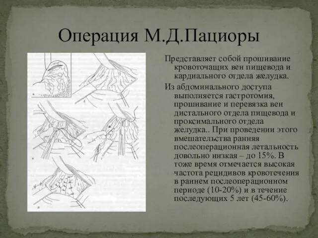 Операция М.Д.Пациоры Представляет собой прошивание кровоточащих вен пищевода и кардиального отдела желудка.