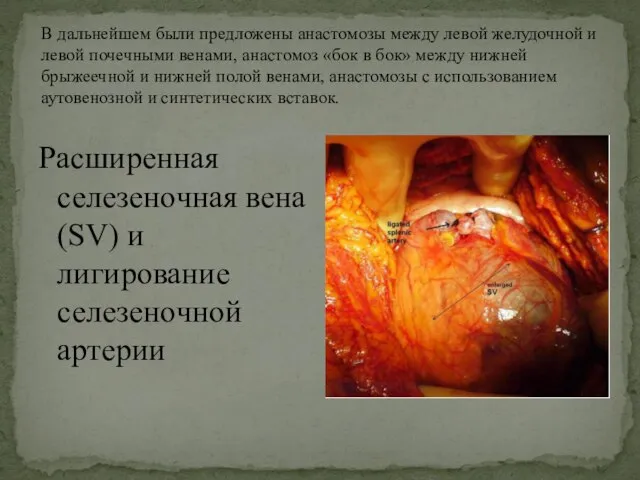 В дальнейшем были предложены анастомозы между левой желудочной и левой почечными венами,