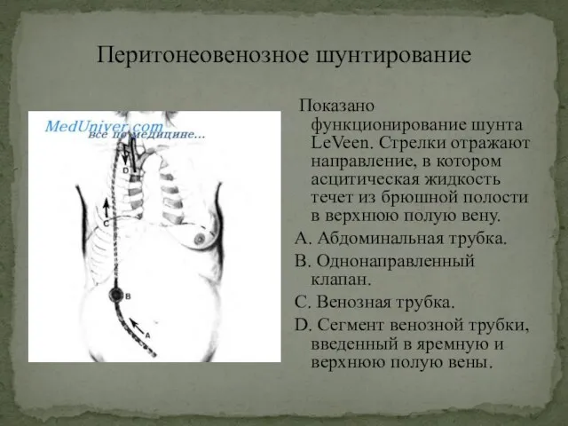 Перитонеовенозное шунтирование Показано функционирование шунта LeVeen. Стрелки отражают направление, в котором асцитическая