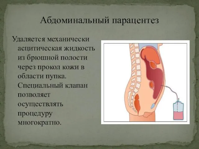 Абдоминальный парацентез Удаляется механически асцитическая жидкость из брюшной полости через прокол кожи