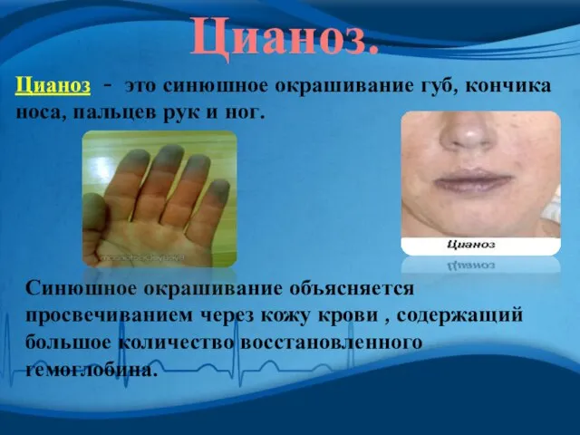 Цианоз. Цианоз - это синюшное окрашивание губ, кончика носа, пальцев рук и