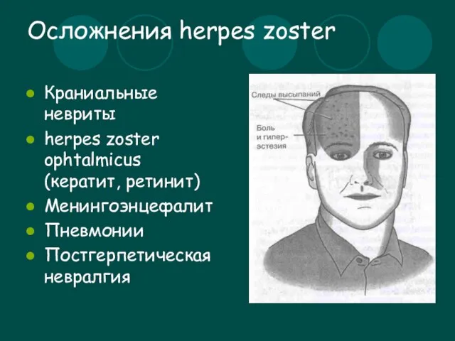 Осложнения herpes zoster Краниальные невриты herpes zoster ophtalmicus (кератит, ретинит) Менингоэнцефалит Пневмонии Постгерпетическая невралгия