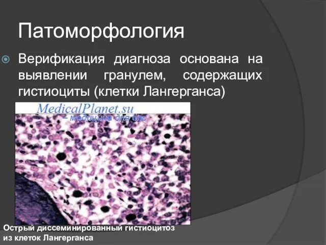 Патоморфология Верификация диагноза основана на выявлении гранулем, содержащих гистиоциты (клетки Лангерганса) Острый