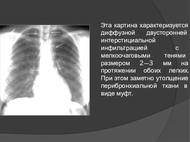 Эта картина характеризуется диффузной двусторонней интерстициальной инфильтрацией с мелкоочаговыми тенями размером 2—3