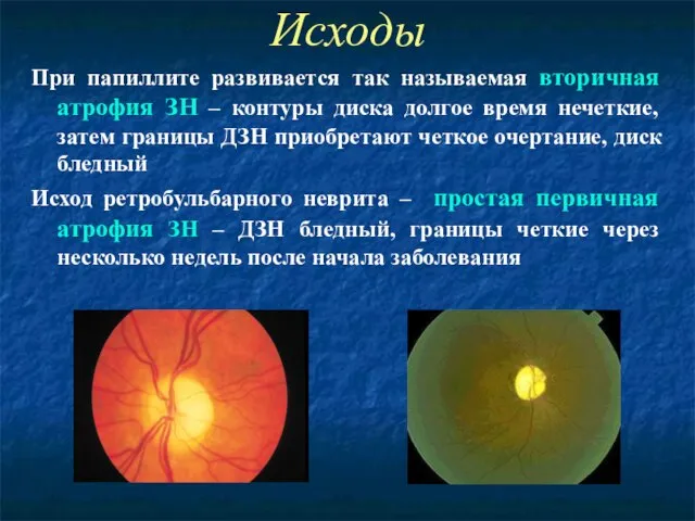 Исходы При папиллите развивается так называемая вторичная атрофия ЗН – контуры диска
