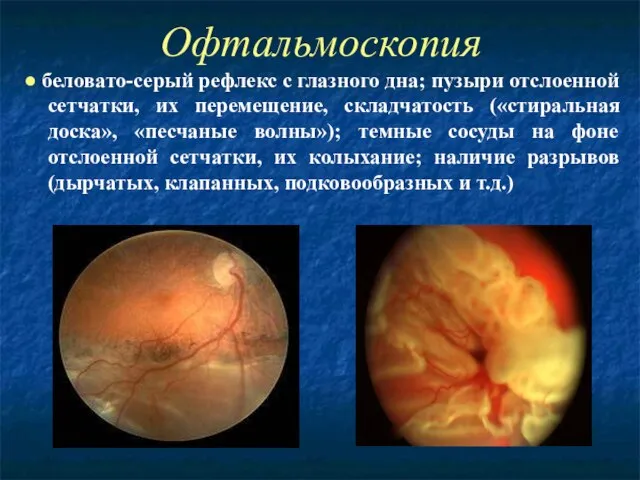 Офтальмоскопия ● беловато-серый рефлекс с глазного дна; пузыри отслоенной сетчатки, их перемещение,