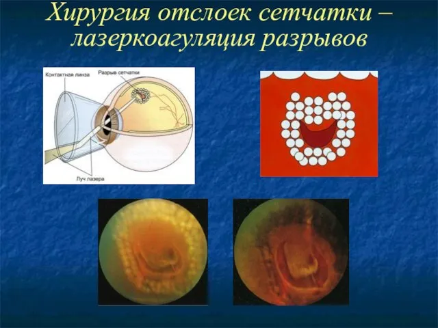 Хирургия отслоек сетчатки – лазеркоагуляция разрывов