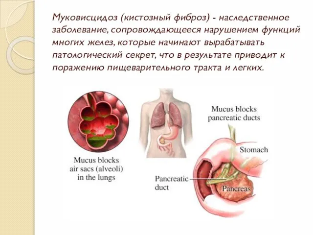 Муковисцидоз (кистозный фиброз) - наследственное заболевание, сопровождающееся нарушением функций многих желез, которые