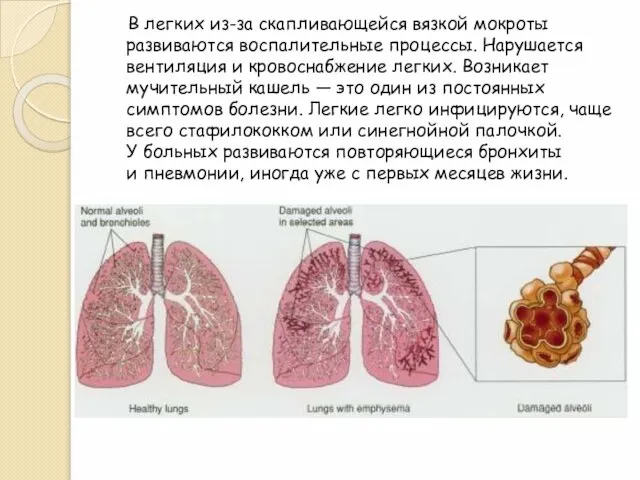 В легких из-за скапливающейся вязкой мокроты развиваются воспалительные процессы. Нарушается вентиляция и