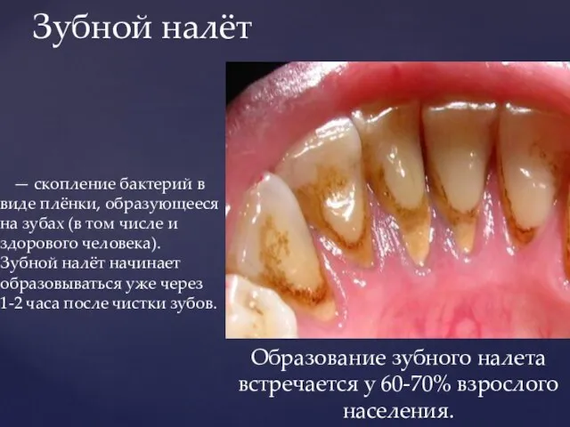 — скопление бактерий в виде плёнки, образующееся на зубах (в том числе