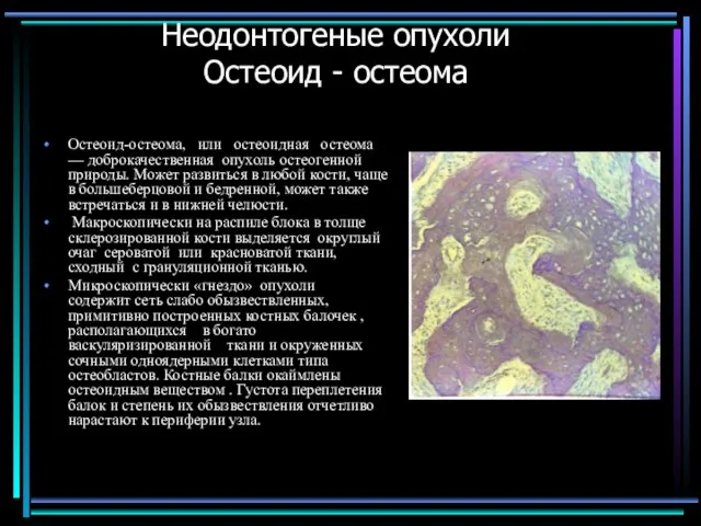 Неодонтогеные опухоли Остеоид - остеома Остеоид-остеома, или остеоидная остеома — доброкачественная опухоль