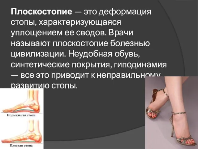 Плоскостопие — это деформация стопы, характеризующаяся уплощением ее сводов. Врачи называют плоскостопие