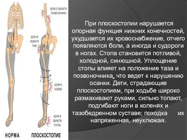 При плоскостопии нарушается опорная функция нижних конечностей, ухудшается их кровоснабжение, отчего появляются