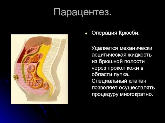 Парацентез. Операция Крюсби. Удаляется механически асцитическая жидкость из брюшной полости через прокол