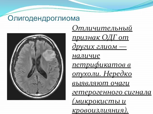 Олигодендроглиома Отличительный признак ОДГ от других глиом — наличие петрификатов в опухоли.