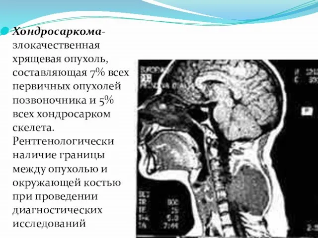 Хондросаркома- злокачественная хрящевая опухоль, составляющая 7% всех первичных опухолей позвоночника и 5%