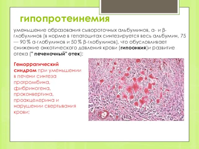 гипопротеинемия уменьшение образования сывороточных альбуминов, α- и β-глобулинов (в норме в гепатоцитах