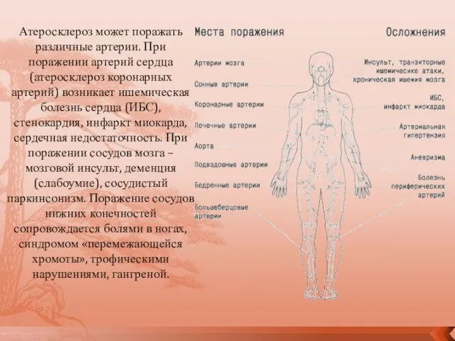 Атеросклероз может поражать различные артерии. При поражении артерий сердца (атеросклероз коронарных артерий)