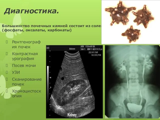 Диагностика. Большинство почечных камней состоит из солей кальция(фосфаты, оксалаты, карбонаты) Рентгенография почек