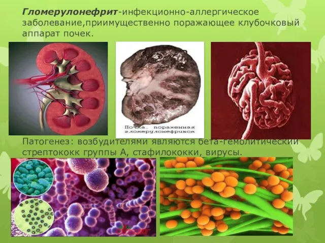 Гломерулонефрит-инфекционно-аллергическое заболевание,приимущественно поражающее клубочковый аппарат почек. Патогенез: возбудителями являются бета-гемолитический стрептококк группы А, стафилококки, вирусы.