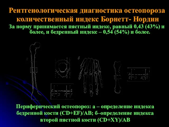 Рентгенологическая диагностика остеопороза количественный индекс Борнетт- Нордин За норму принимается пястный индекс,