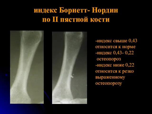 индекс Борнетт- Нордин по II пястной кости -индекс свыше 0,43 относится к