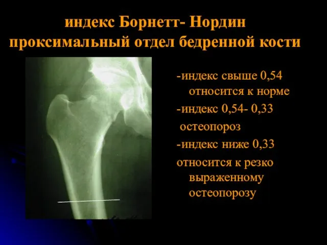 индекс Борнетт- Нордин проксимальный отдел бедренной кости -индекс свыше 0,54 относится к