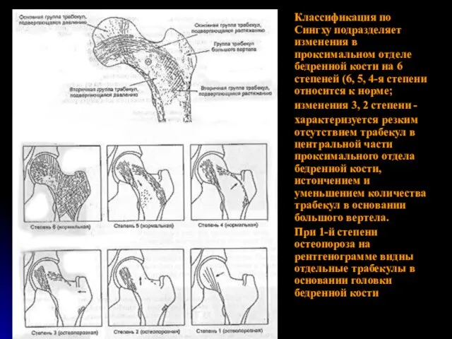 Классификация по Сингху подразделяет изменения в проксимальном отделе бедренной кости на 6