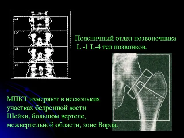 Поясничный отдел позвоночника L -1 L-4 тел позвонков. МПКТ измеряют в нескольких