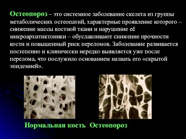 Нормальная кость Остеопороз Остеопороз – это системное заболевание скелета из группы метаболических