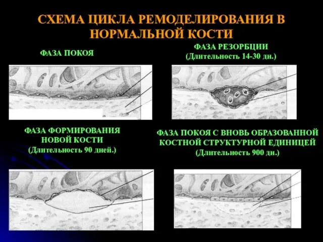 СХЕМА ЦИКЛА РЕМОДЕЛИРОВАНИЯ В НОРМАЛЬНОЙ КОСТИ ФАЗА ПОКОЯ ФАЗА РЕЗОРБЦИИ (Длительность 14-30