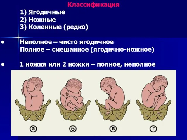 Классификация 1) Ягодичные 2) Ножные 3) Коленные (редко) Неполное – чисто ягодичное