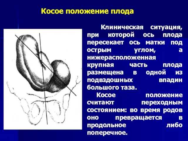 Клиническая ситуация, при которой ось плода пересекает ось матки под острым углом,