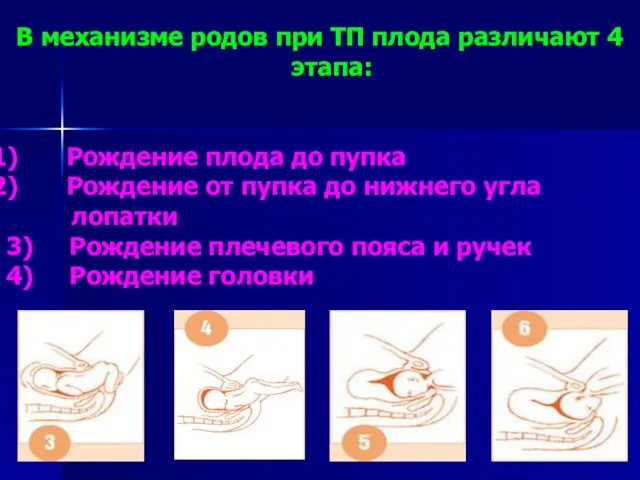 В механизме родов при ТП плода различают 4 этапа: Рождение плода до