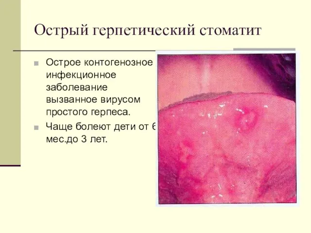 Острый герпетический стоматит Острое контогенозное инфекционное заболевание вызванное вирусом простого герпеса. Чаще