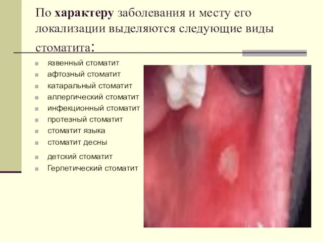 По характеру заболевания и месту его локализации выделяются следующие виды стоматита: язвенный