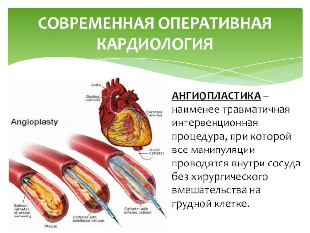 СОВРЕМЕННАЯ ОПЕРАТИВНАЯ КАРДИОЛОГИЯ АНГИОПЛАСТИКА – наименее травматичная интервенционная процедура, при которой все