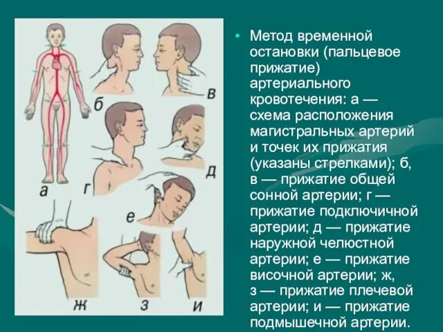 Метод временной остановки (пальцевое прижатие) артериального кровотечения: а — схема расположения магистральных