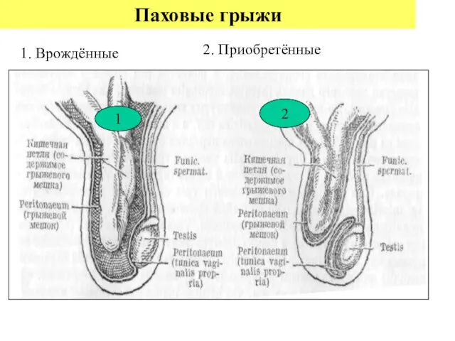 Паховые грыжи 1 2 1. Врождённые 2. Приобретённые