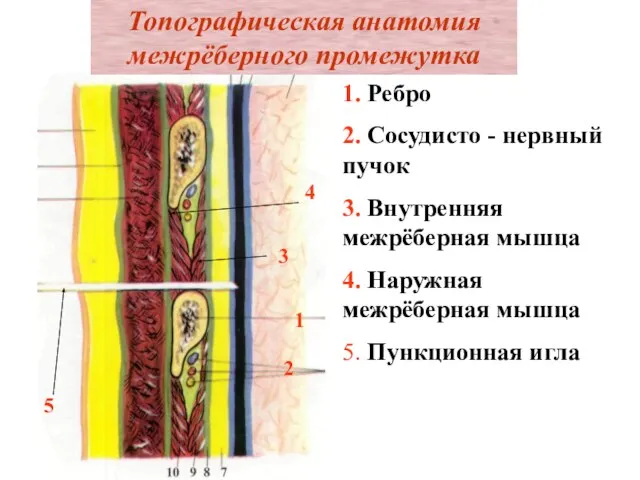 Топографическая анатомия межрёберного промежутка 1. Ребро 2. Сосудисто - нервный пучок 3.